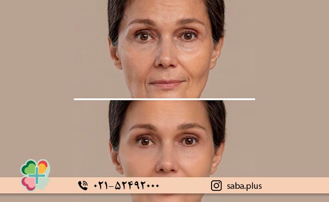 ویژگی_های-بوتاکس-دیسپورت