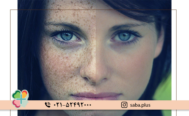 انواع-لکه_های-صورت-و-رنگ-آن_ها