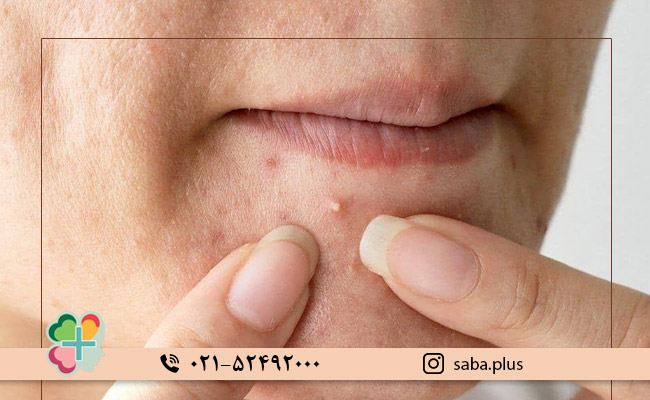 بررسی-انواع-لک-از-نظر-علت-به-وجود-آمدن