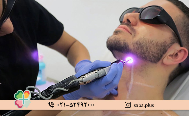 لیزر-موهای-زائد-صورت-در-مردان