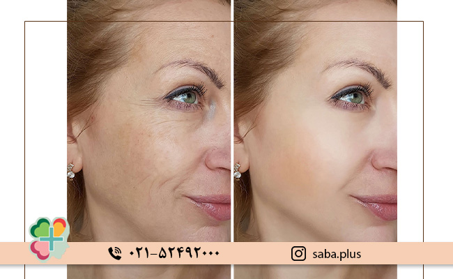 مزایای-تزریق-ژل-پروفیلو