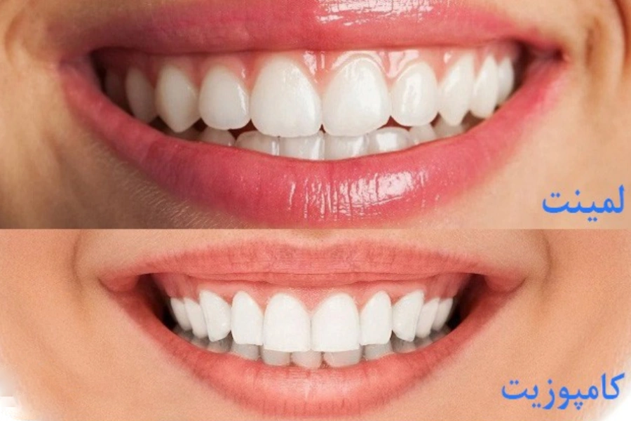 فرق لمینت و کامپوزیت