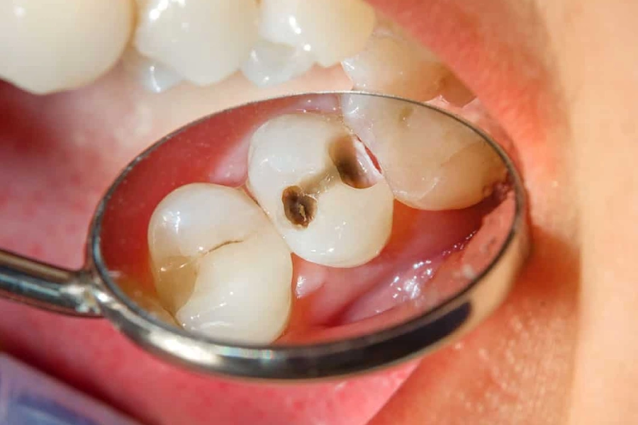 چگونه می‌ توان از عفونت ریشه دندان پیشگیری کرد؟